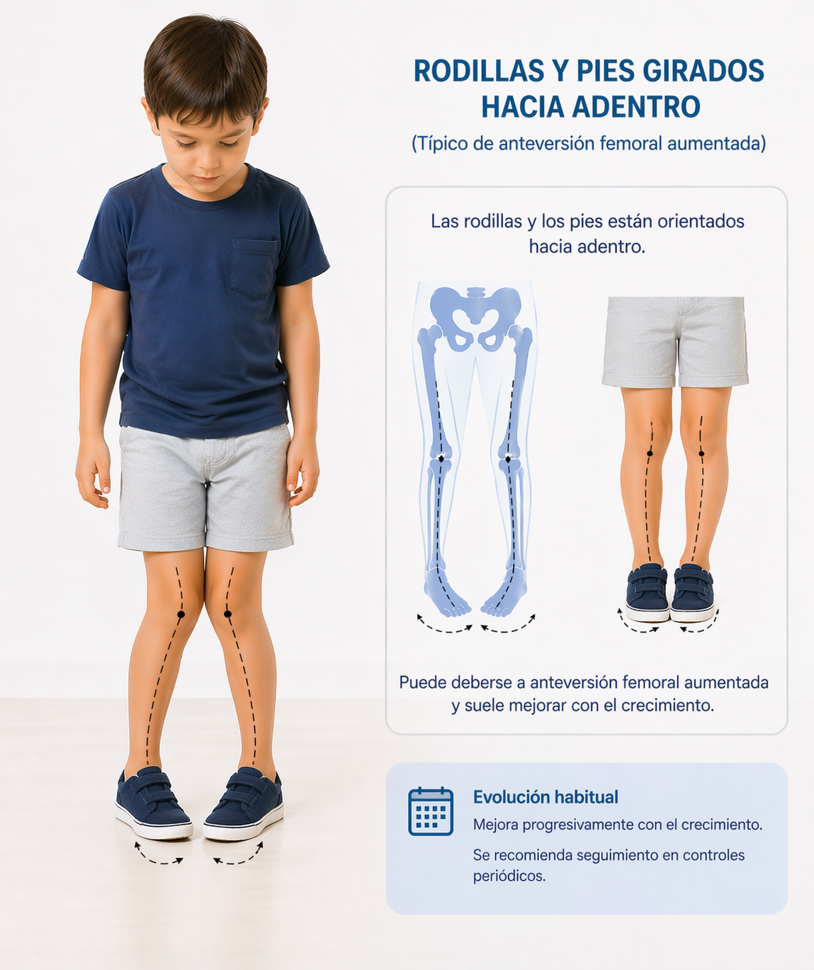 Ilustración de anteversión femoral relacionada con la marcha intrarrotada.
