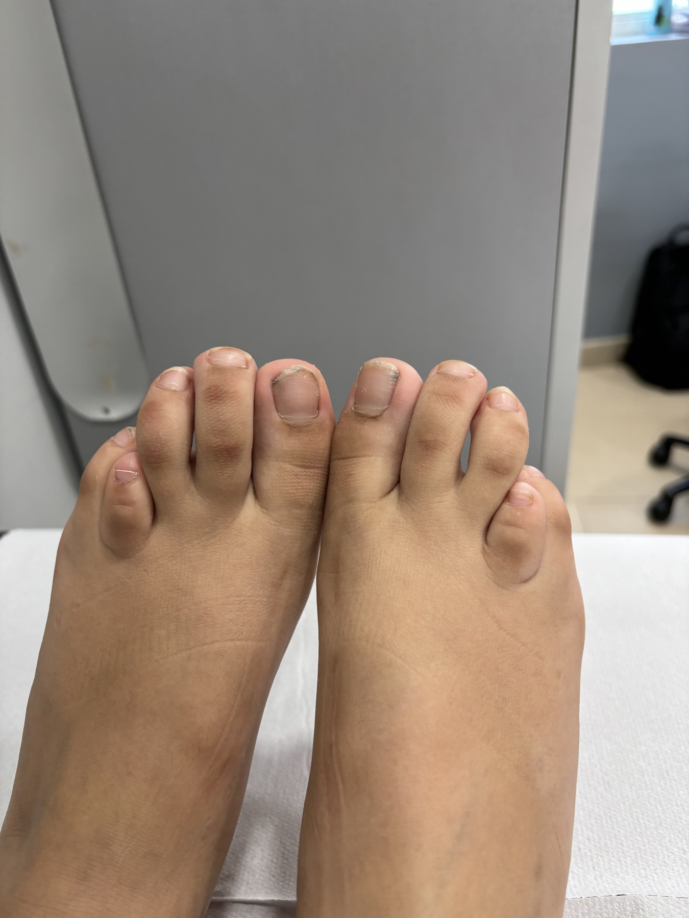 Imagen inicial de braquimetatarsia con dedo corto del pie.