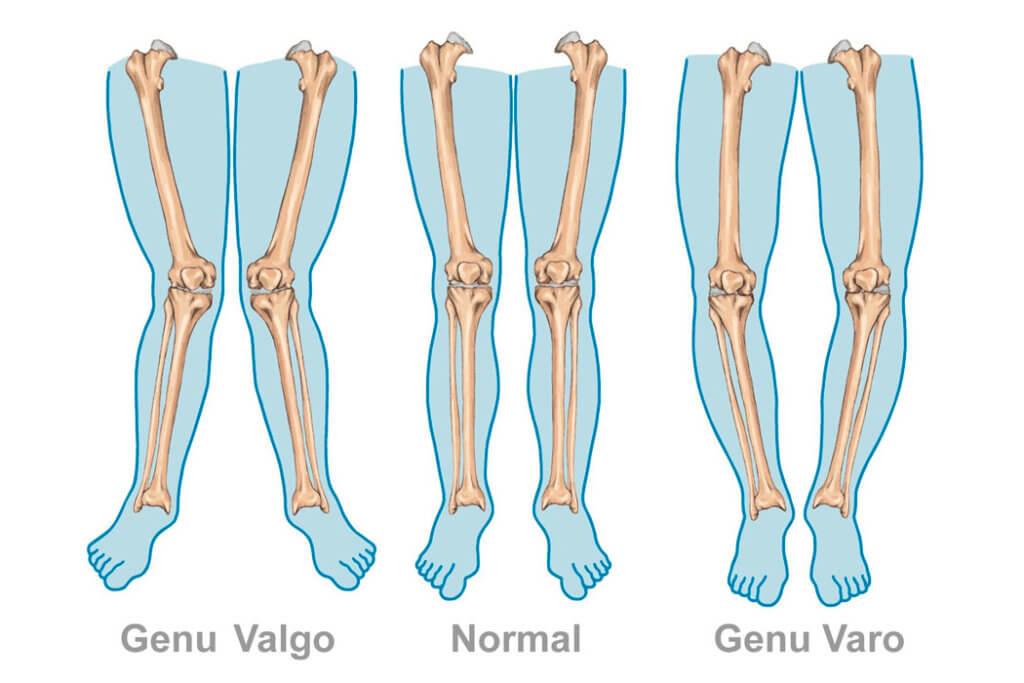 Imagen comparativa de alineación en genu varo y genu valgo.