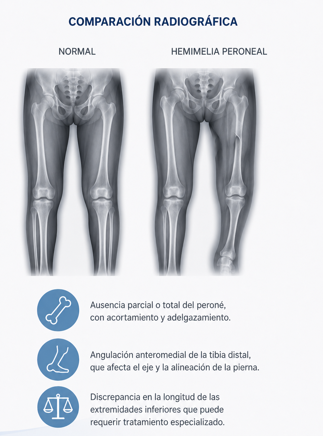 Imagen adicional de hemimelia peroneal.