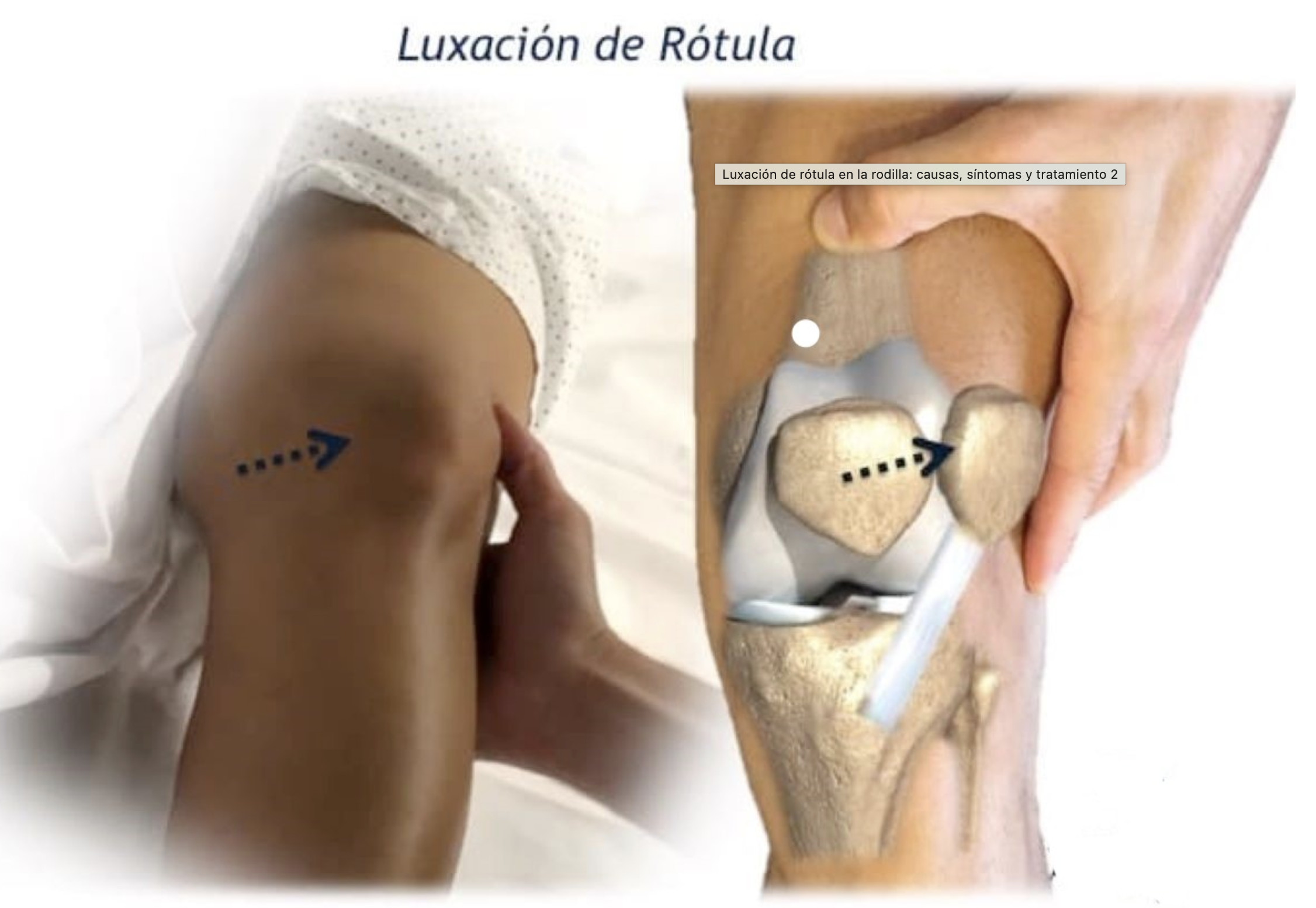 Ilustración de luxación de rótula en un paciente pediátrico.