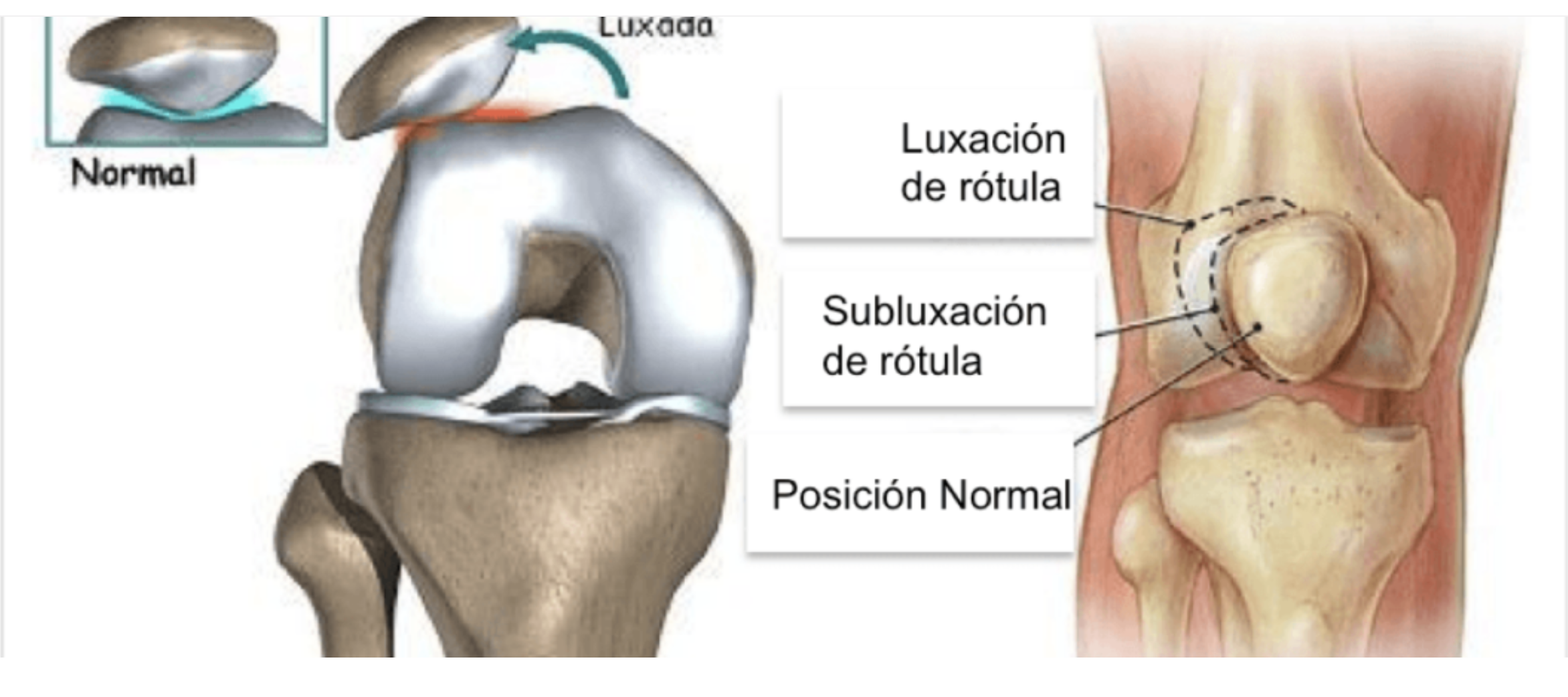 Segunda imagen explicativa de inestabilidad rotuliana.