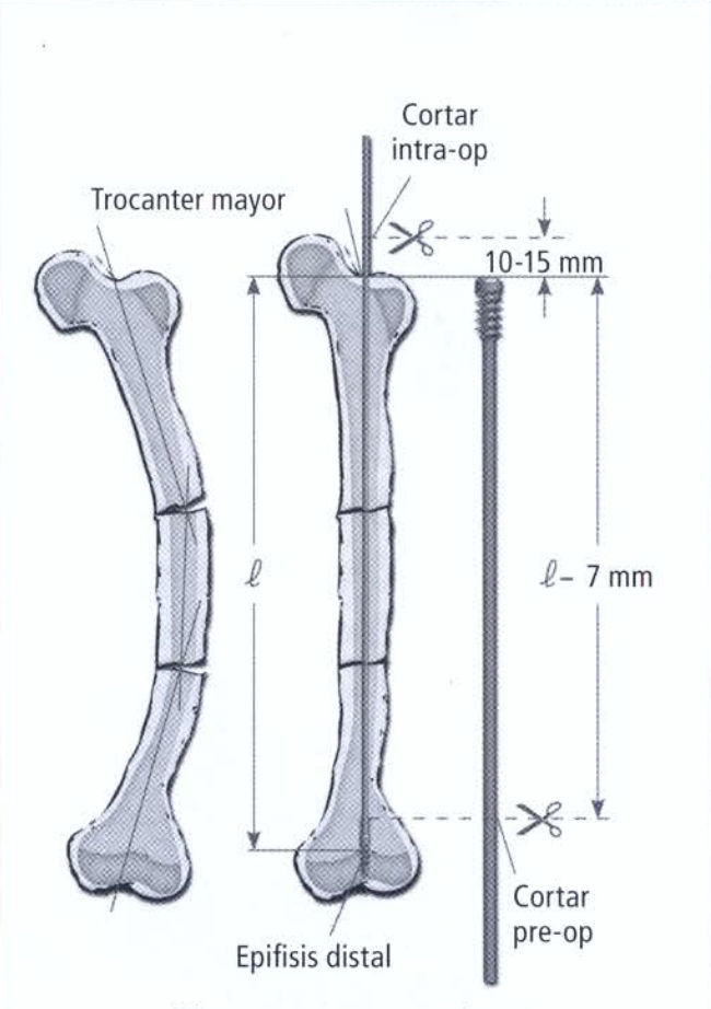Tercera ilustración relacionada con osteogénesis imperfecta.