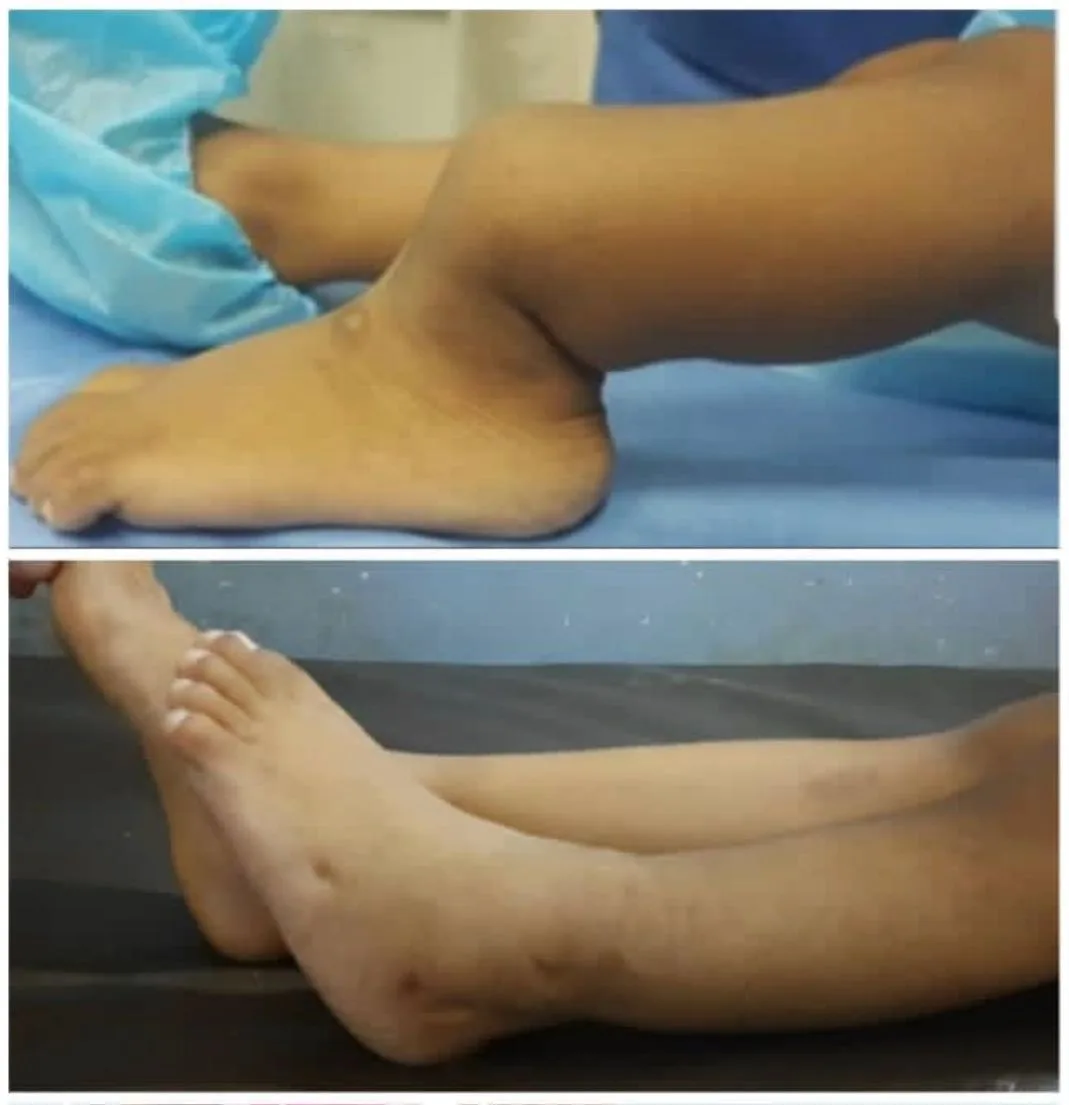 Imagen representativa de angulación tibial asociada a pseudoartrosis congénita.